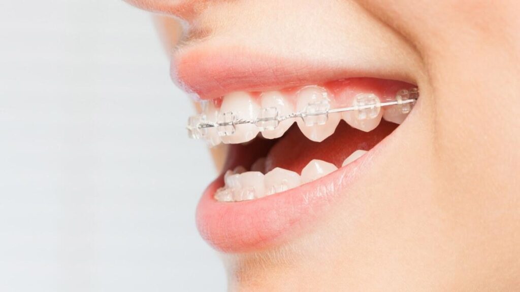 Types Of Invisible Dental Braces