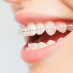 Types Of Invisible Dental Braces