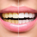 The Best Teeth Whitening Options