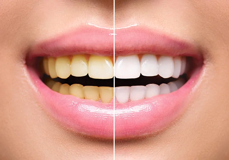 The Best Teeth Whitening Options